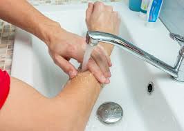 first aid management for a scold or a burn