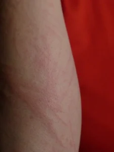 skin rash on arm